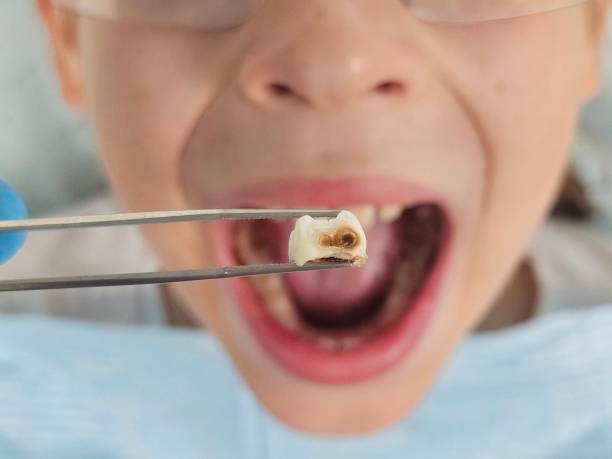 Best Broken or Chipped Tooth Repair in Cresson, TX